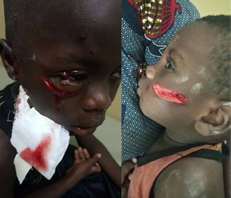 Stray Dogs Bite 5 Kids in Keta