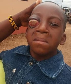 5-Year old Needs Support to Correct Eye Defect